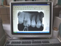 デジタルレントゲン